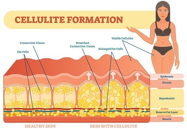 What You Need To Know About Cellulite Treatments European